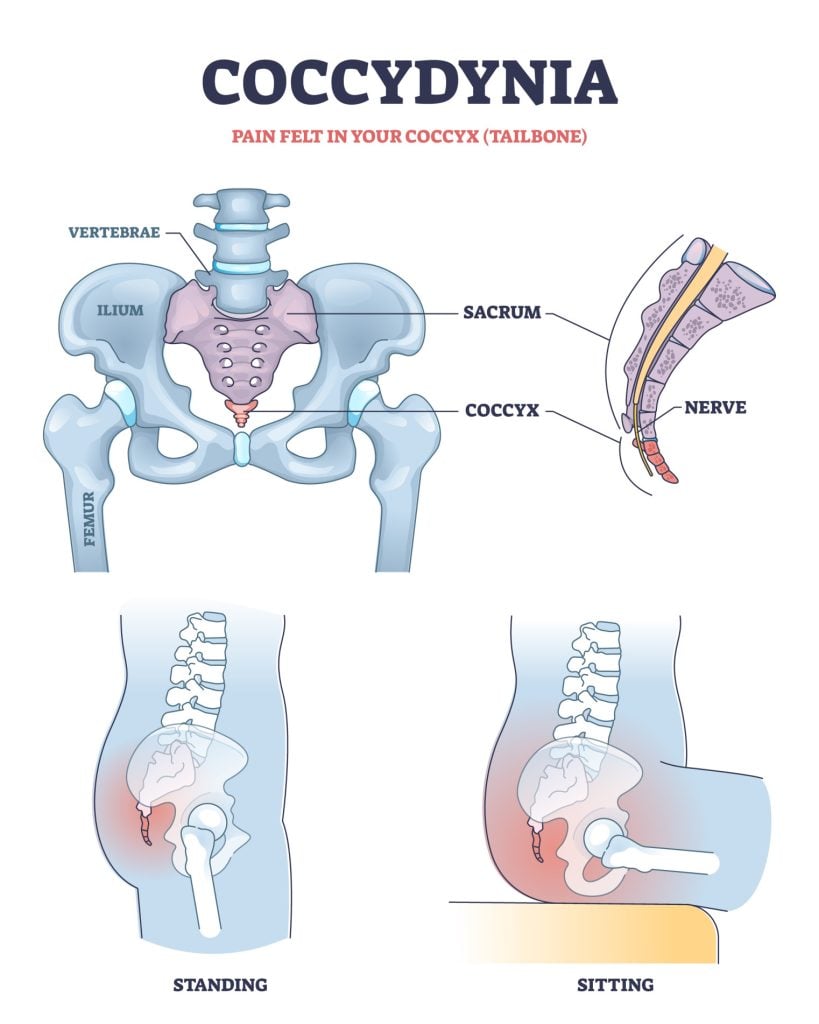 Coccydynia as pain felt in coccyx or tailbone anatomical outline diagram. Labeled educational back bone structure and painful nerve in standing or sitting positions vector illustration. Medical scheme