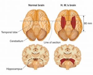 patient hm brain